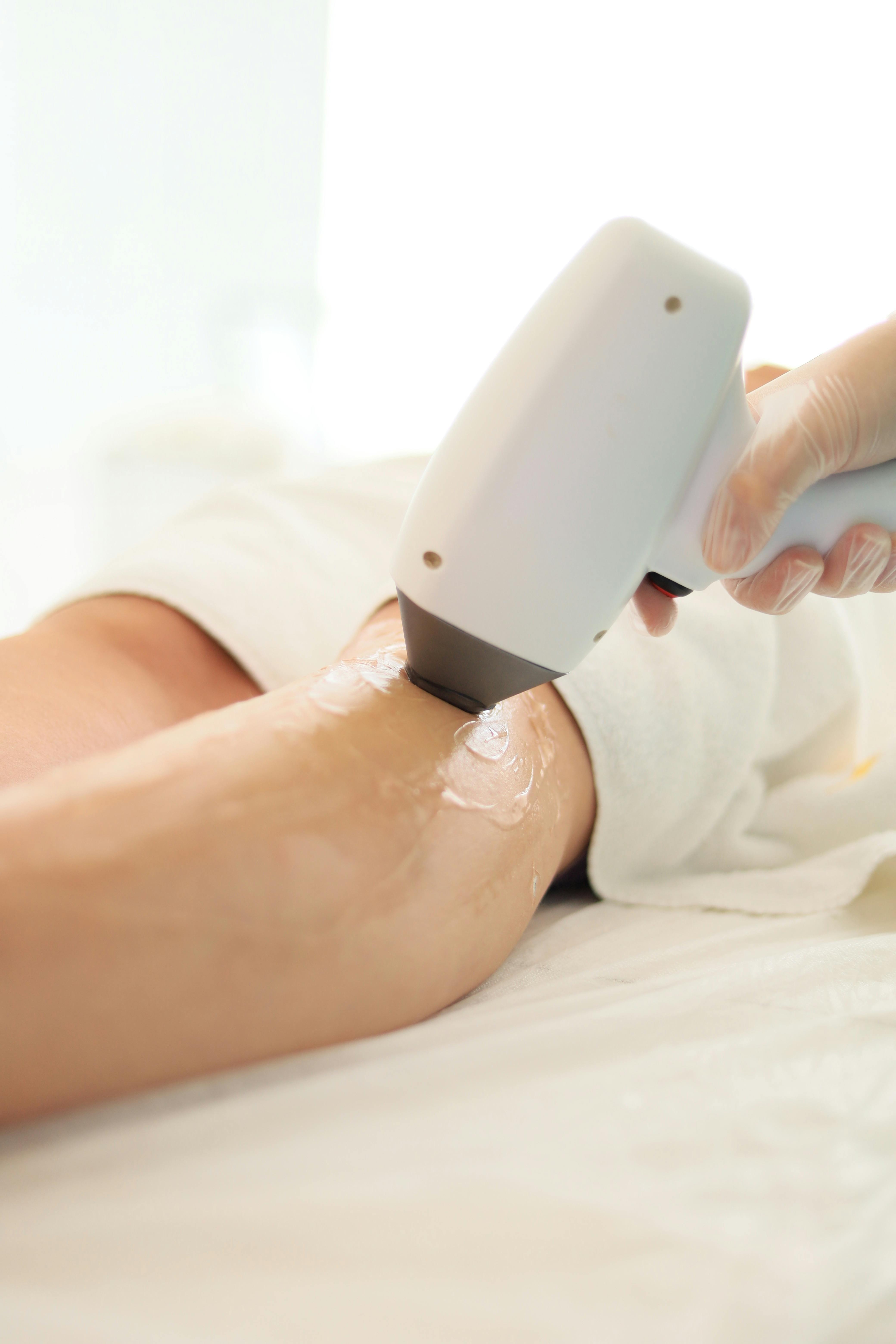Laser hair removal treatment